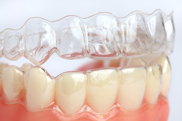 Popular Teeth Straightening Treatments Used By General Dentists